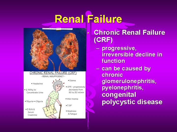 Renal Failure • Chronic Renal Failure (CRF) – progressive, irreversible decline in function –