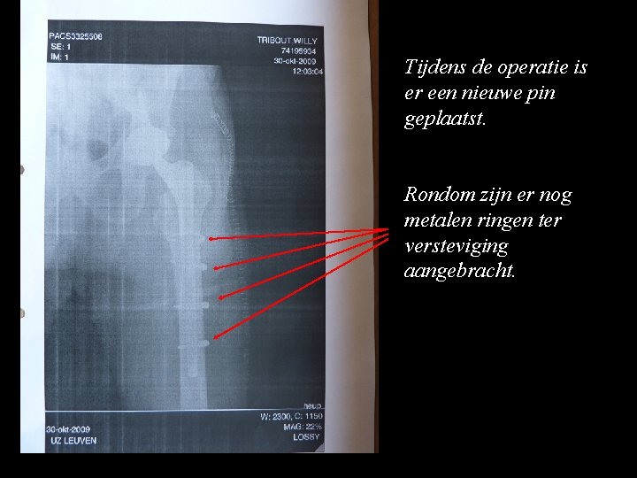 Tijdens de operatie is er een nieuwe pin geplaatst. Rondom zijn er nog metalen