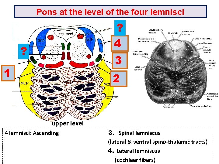 Pons at the level of the four lemnisci ? 4 ? 3 1 2