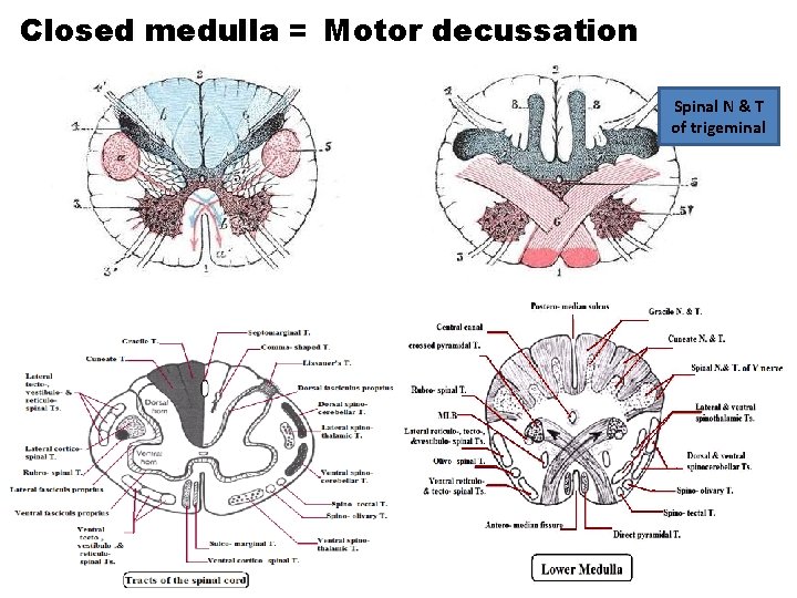 Closed medulla = Motor decussation Spinal N & T of trigeminal 