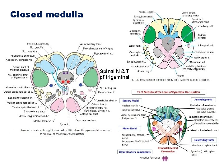 Closed medulla Spinal N & T of trigeminal 
