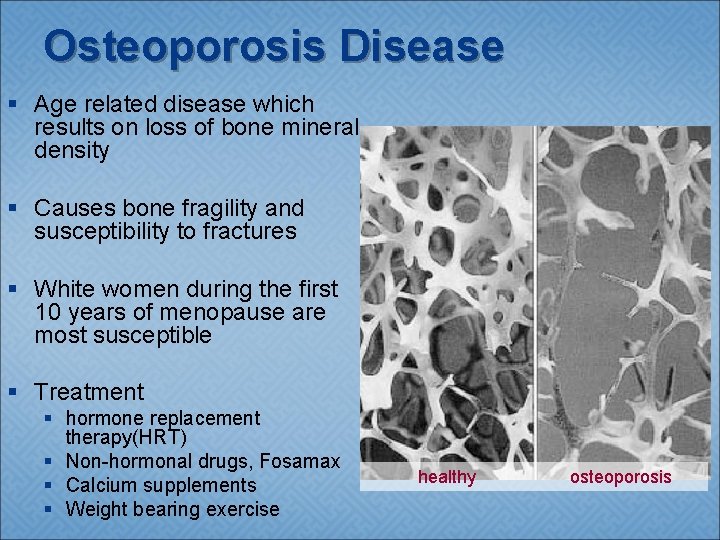 Osteoporosis Disease § Age related disease which results on loss of bone mineral density