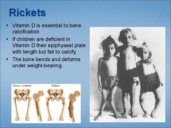 Rickets § Vitamin D is essential to bone calcification § If children are deficient