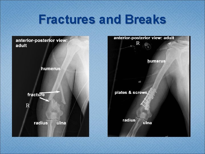 Fractures and Breaks 