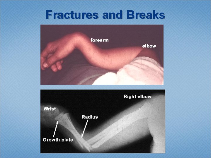 Fractures and Breaks 