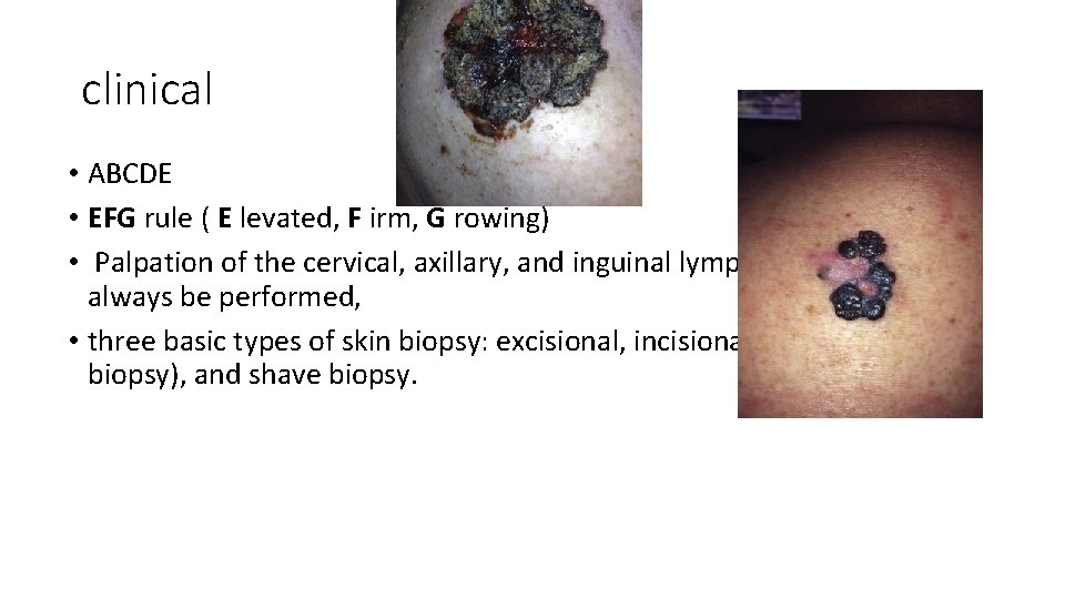 clinical • ABCDE • EFG rule ( E levated, F irm, G rowing) •