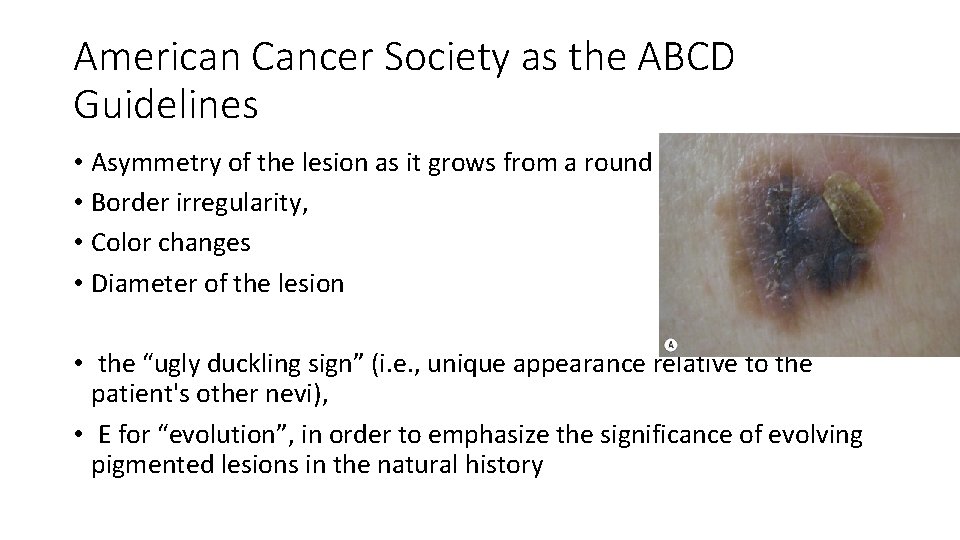 American Cancer Society as the ABCD Guidelines • Asymmetry of the lesion as it