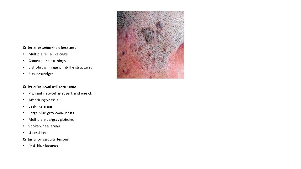 Criteria for seborrheic keratosis • Multiple milia-like cysts • Comedo-like openings • Light-brown fingerprint-like