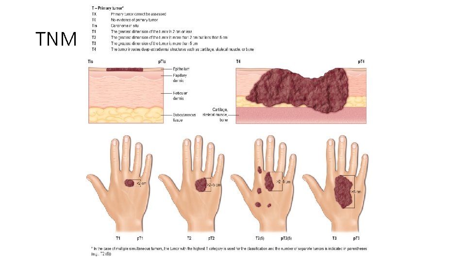 TNM classification 