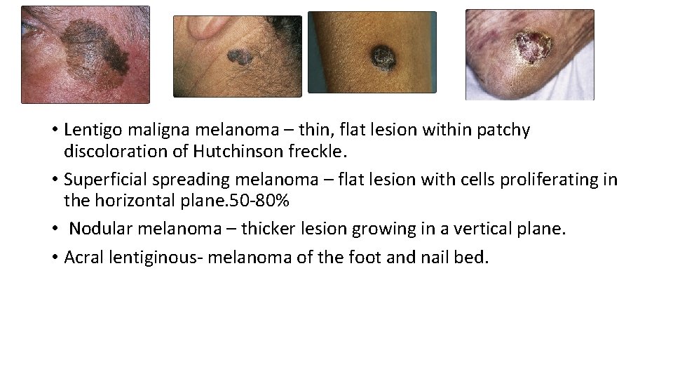  • Lentigo maligna melanoma – thin, flat lesion within patchy discoloration of Hutchinson