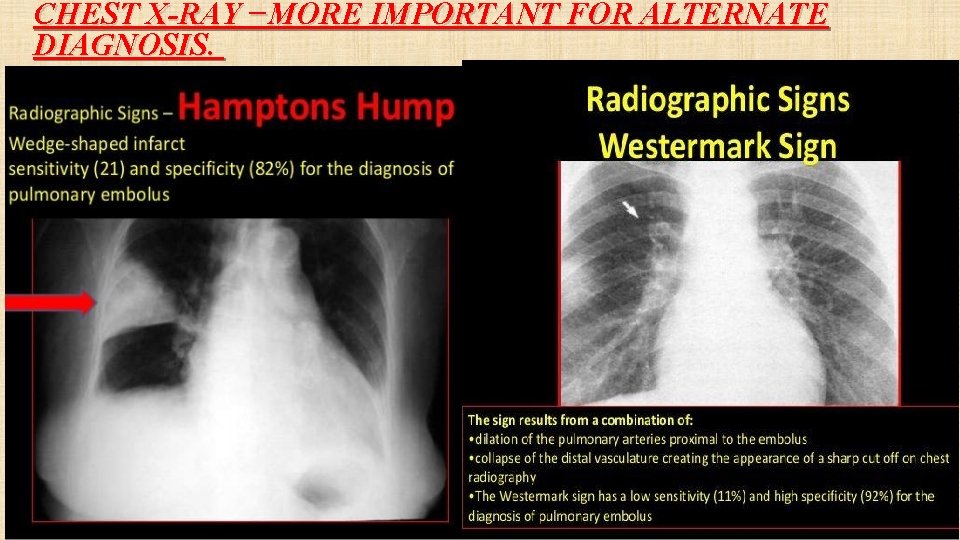 CHEST X-RAY −MORE IMPORTANT FOR ALTERNATE DIAGNOSIS. 