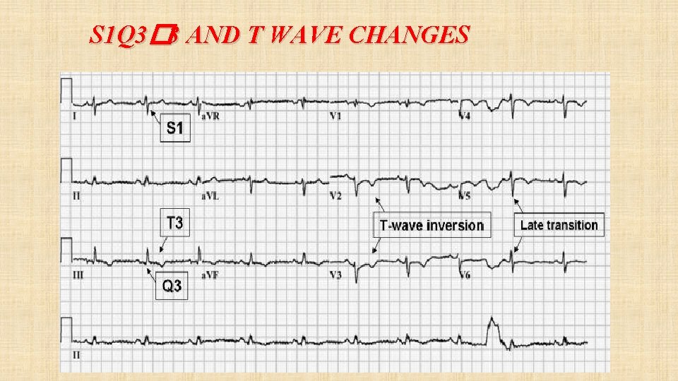 S 1 Q 3� 3 AND T WAVE CHANGES 