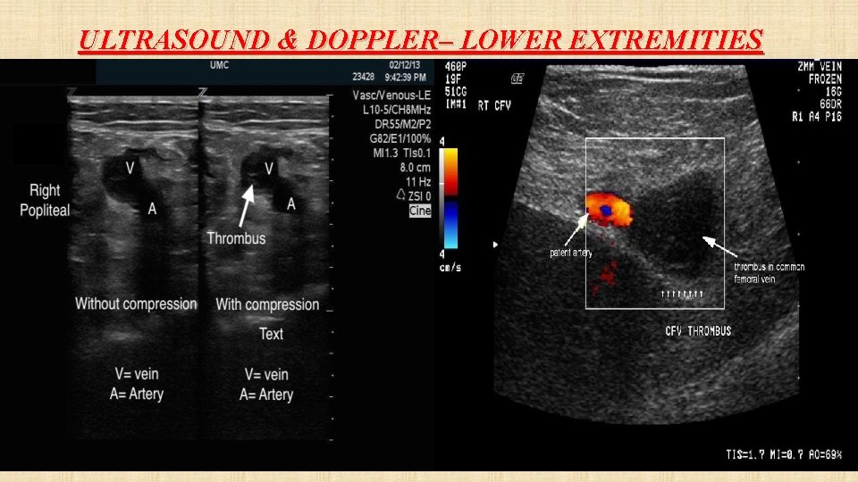 ULTRASOUND & DOPPLER– LOWER EXTREMITIES 