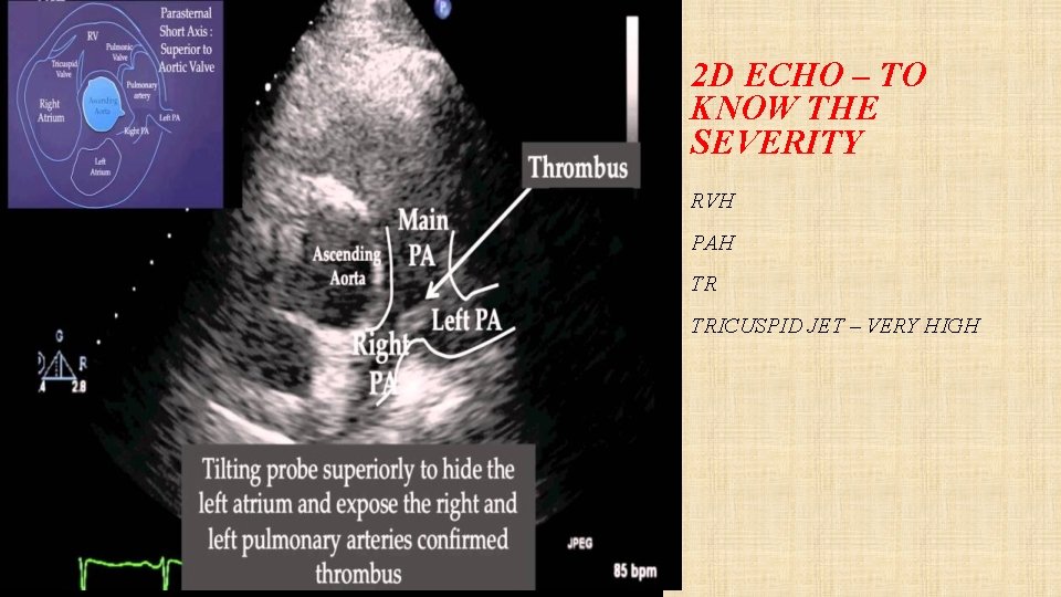 2 D ECHO – TO KNOW THE SEVERITY RVH PAH TR TRICUSPID JET –