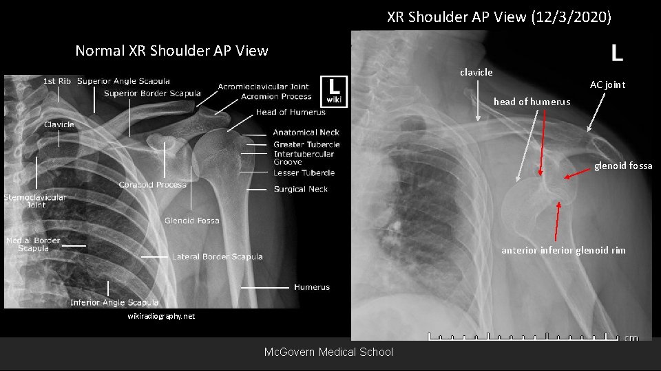 XR Shoulder AP View (12/3/2020) Normal XR Shoulder AP View clavicle AC joint head