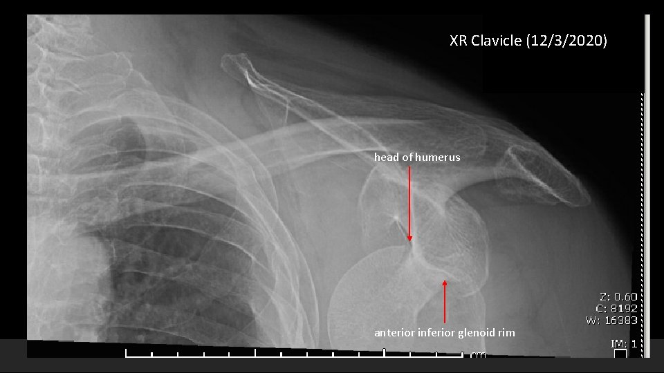 XR Clavicle (12/3/2020) head of humerus anterior inferior glenoid rim Mc. Govern Medical School