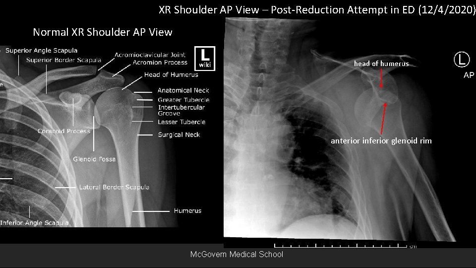 XR Shoulder AP View – Post-Reduction Attempt in ED (12/4/2020) Normal XR Shoulder AP