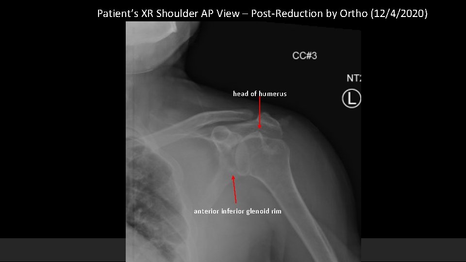 Patient’s XR Shoulder AP View – Post-Reduction by Ortho (12/4/2020) head of humerus anterior