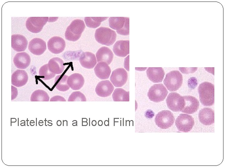Platelets on a Blood Film 