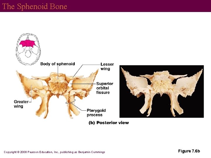 The Sphenoid Bone Copyright © 2008 Pearson Education, Inc. , publishing as Benjamin Cummings