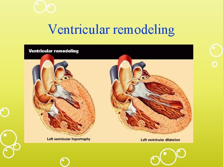 Ventricular remodeling 
