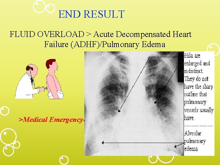 END RESULT FLUID OVERLOAD > Acute Decompensated Heart Failure (ADHF)/Pulmonary Edema >Medical Emergency! 