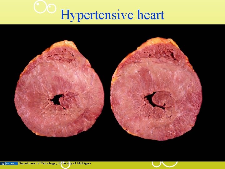 Hypertensive heart Department of Pathology, University of Michigan 