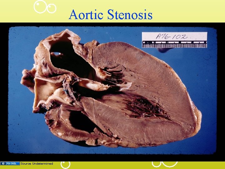 Aortic Stenosis Source Undetermined 