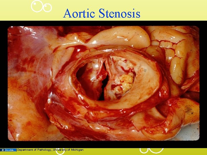 Aortic Stenosis Department of Pathology, University of Michigan 