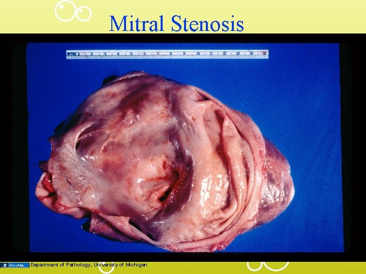 Mitral Stenosis Department of Pathology, University of Michigan 