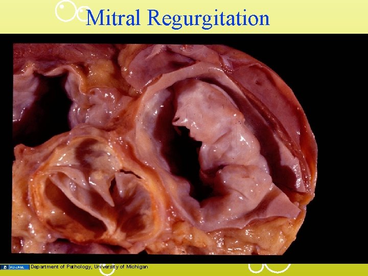 Mitral Regurgitation Department of Pathology, University of Michigan 