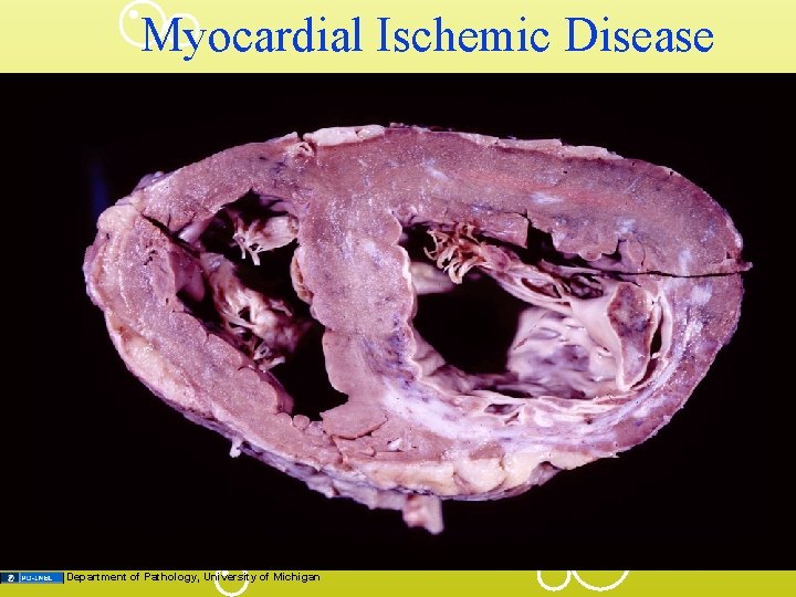 Myocardial Ischemic Disease Department of Pathology, University of Michigan 