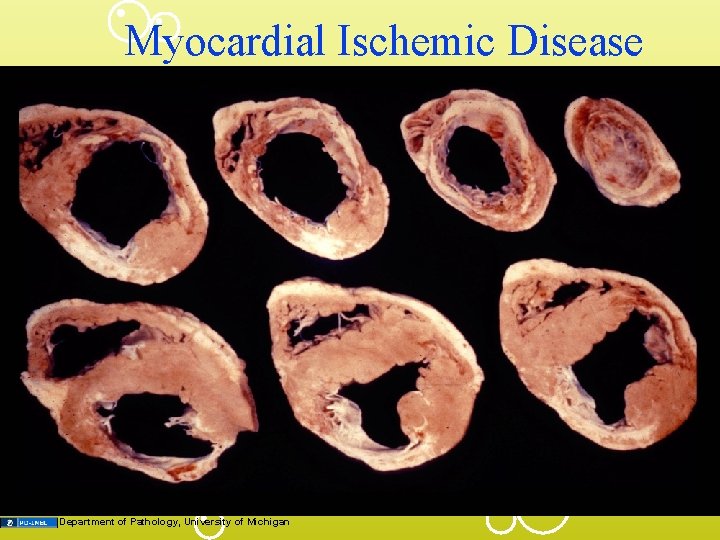 Myocardial Ischemic Disease Department of Pathology, University of Michigan 