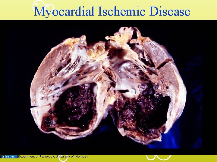 Myocardial Ischemic Disease Department of Pathology, University of Michigan 