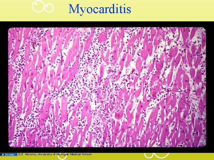 Myocarditis G. D. Abrams, University of Michigan Medical School 