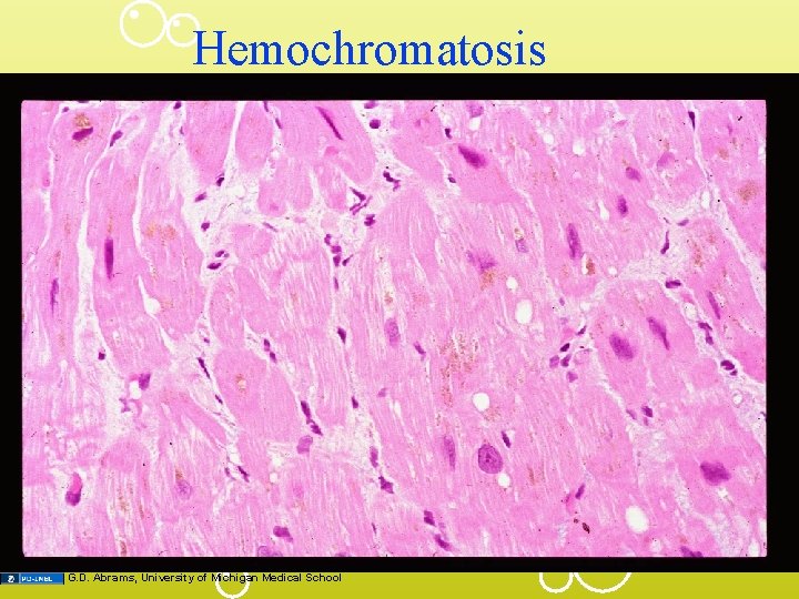 Hemochromatosis G. D. Abrams, University of Michigan Medical School 