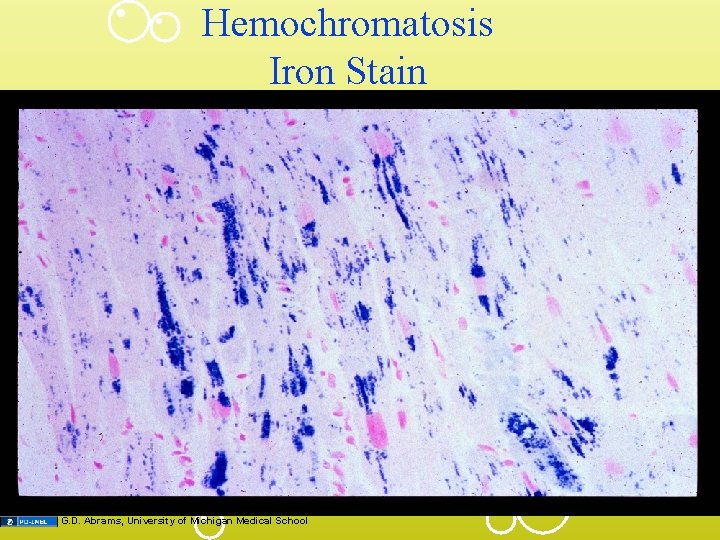 Hemochromatosis Iron Stain G. D. Abrams, University of Michigan Medical School 