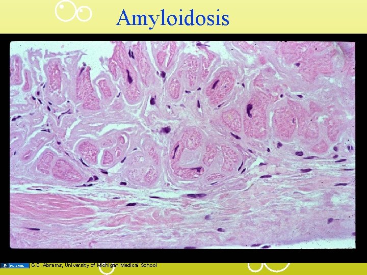 Amyloidosis G. D. Abrams, University of Michigan Medical School 