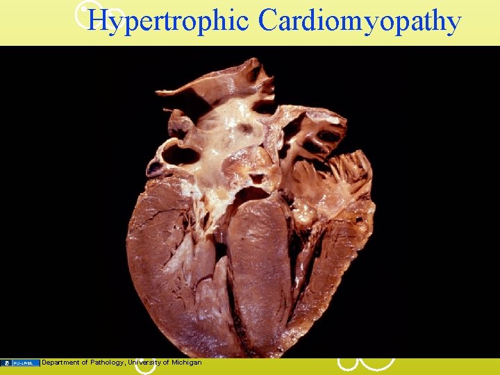 Hypertrophic Cardiomyopathy Department of Pathology, University of Michigan 