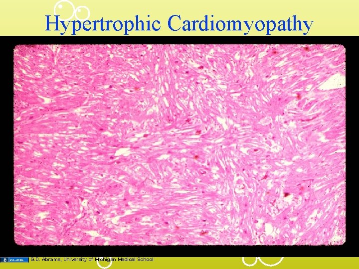 Hypertrophic Cardiomyopathy G. D. Abrams, University of Michigan Medical School 