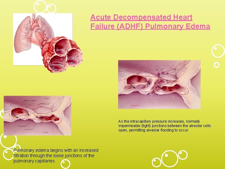 Acute Decompensated Heart Failure (ADHF) Pulmonary Edema As the intracapillary pressure increases, normally impermeable