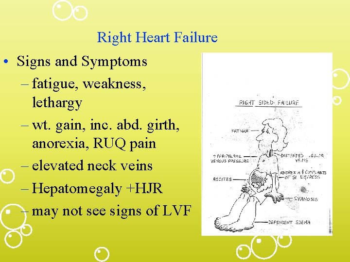 Right Heart Failure • Signs and Symptoms – fatigue, weakness, lethargy – wt. gain,