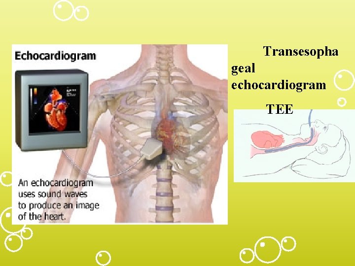 Transesopha geal echocardiogram TEE 