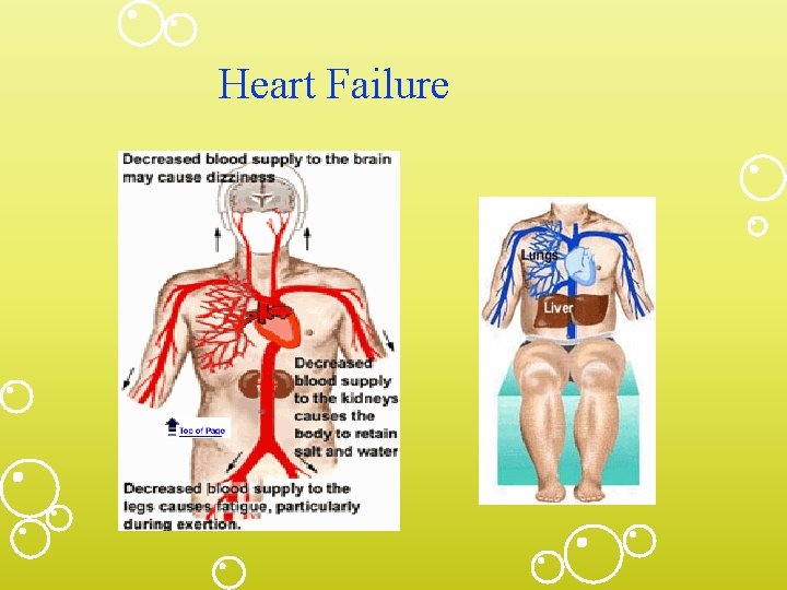 Heart Failure 