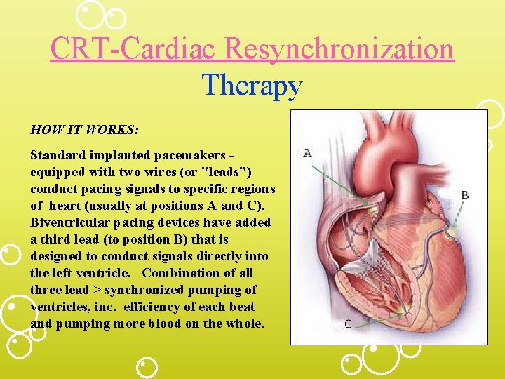 CRT-Cardiac Resynchronization Therapy HOW IT WORKS: Standard implanted pacemakers equipped with two wires (or
