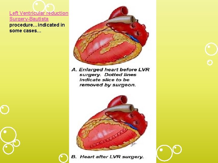 Left Ventricular reduction Surgery-Bautista procedure…indicated in some cases… 