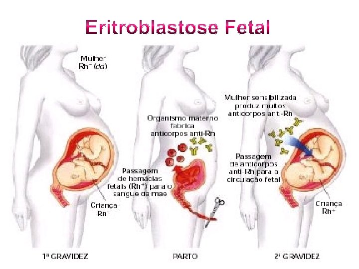 Eritroblastose Fetal 