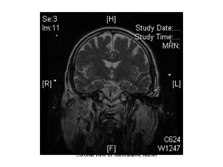 Coronal View of Subthalamic Nuclei 