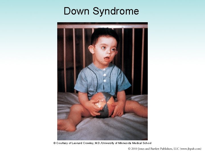 Down Syndrome © Courtesy of Leonard Crowley, M. D. /University of Minnesota Medical School