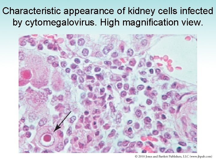 Characteristic appearance of kidney cells infected by cytomegalovirus. High magnification view. 